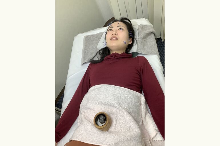 美容鍼灸３