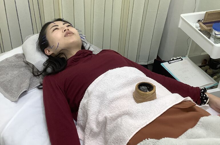 美容鍼灸