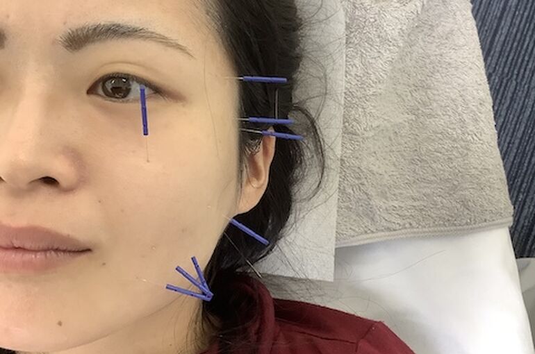 美容鍼