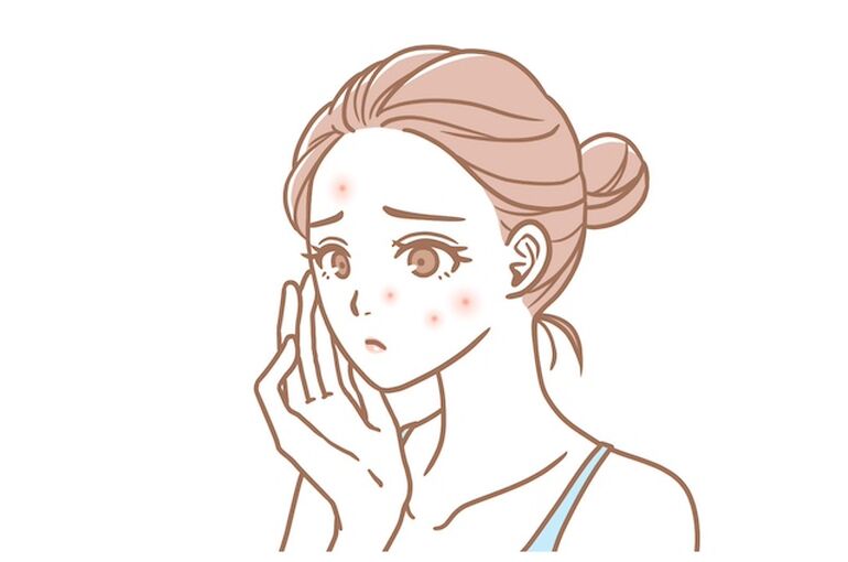 ニキビ
