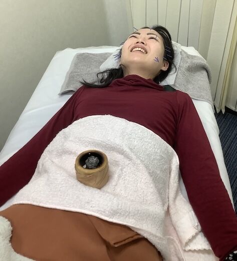 美容鍼トリミング１