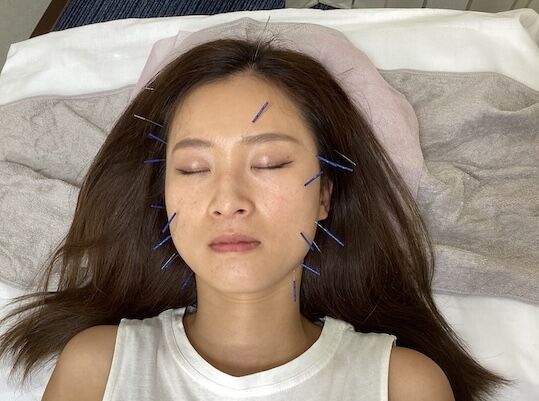 美容鍼トリミング２