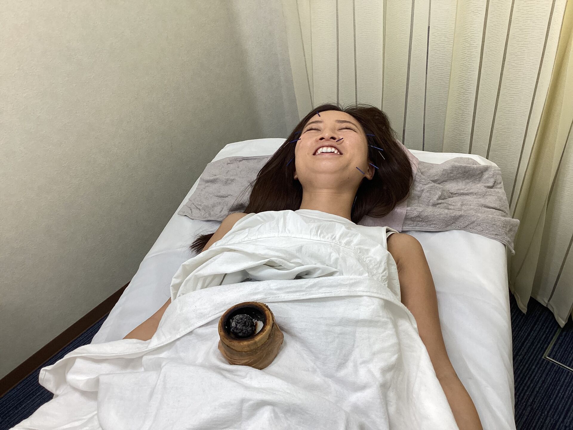 美容鍼トリミング４